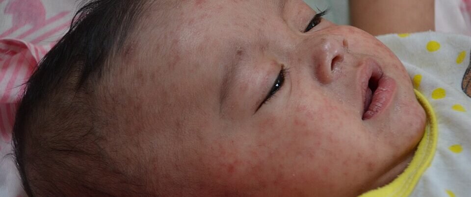 Healthcare workers caring for young children during a measles outbreak at a crowded pediatric hospital